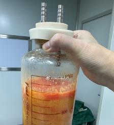 泸州水动力吸脂手术要做多久？